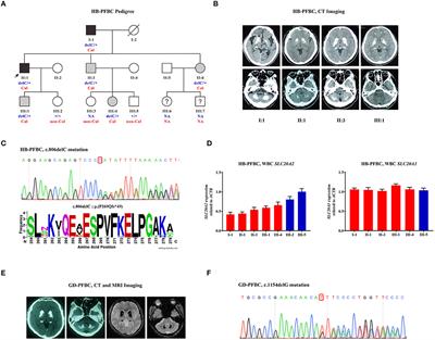 Case Report: Two Novel Frameshift Mutations in SLC20A2 and One Novel Splice Donor Mutation in PDGFB Associated With Primary Familial Brain Calcification